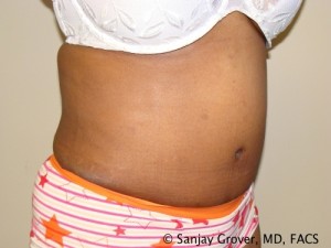 Tummy Tuck Before and After 81 | Sanjay Grover MD FACS