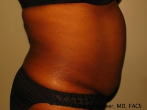 Tummy Tuck Before and After 81 | Grover Aesthetics