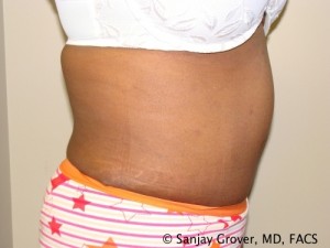Tummy Tuck Before and After 81 | Grover Aesthetics