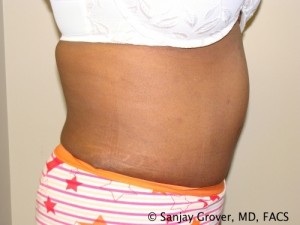 Tummy Tuck Before and After 81 | Sanjay Grover MD FACS