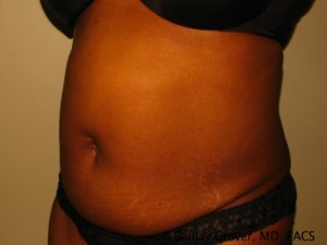 Tummy Tuck Before and After 81 | Grover Aesthetics