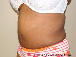 Tummy Tuck Before and After 81 | Sanjay Grover MD FACS