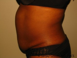 Tummy Tuck Before and After 81 | Grover Aesthetics