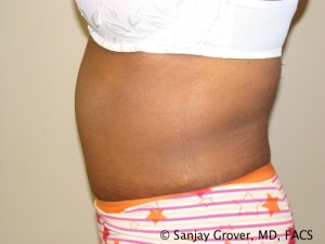 Tummy Tuck Before and After 81 | Sanjay Grover MD FACS