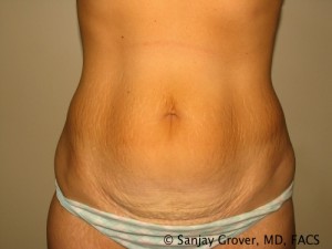 Tummy Tuck Before and After | Grover Aesthetics