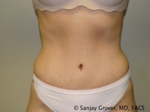 Tummy Tuck Before and After | Grover Aesthetics