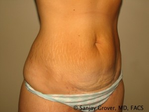 Tummy Tuck Before and After 82 | Grover Aesthetics