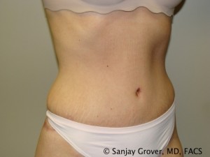 Tummy Tuck Before and After 82 | Grover Aesthetics