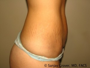 Tummy Tuck Before and After 82 | Grover Aesthetics