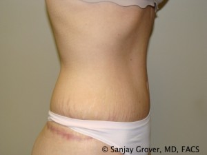 Tummy Tuck Before and After 82 | Grover Aesthetics
