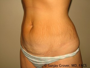 Tummy Tuck Before and After 82 | Grover Aesthetics