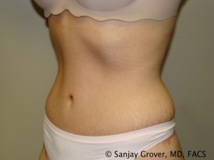 Tummy Tuck Before and After 82 | Grover Aesthetics