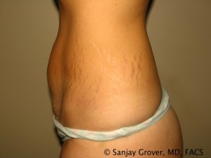 Tummy Tuck Before and After 82 | Grover Aesthetics