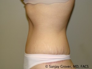 Tummy Tuck Before and After 82 | Grover Aesthetics