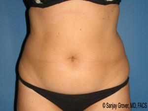 Tummy Tuck Before and After | Grover Aesthetics