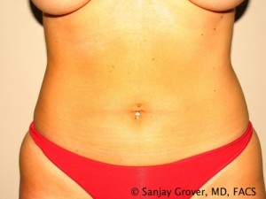 Tummy Tuck Before and After | Grover Aesthetics
