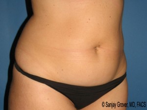 Tummy Tuck Before and After 83 | Grover Aesthetics