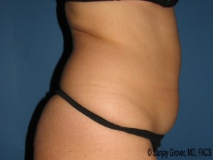 Tummy Tuck Before and After 83 | Sanjay Grover MD FACS