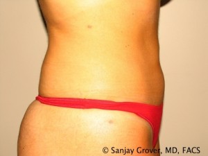 Tummy Tuck Before and After 83 | Grover Aesthetics