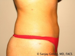 Tummy Tuck Before and After 83 | Sanjay Grover MD FACS