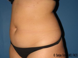 Tummy Tuck Before and After 83 | Sanjay Grover MD FACS