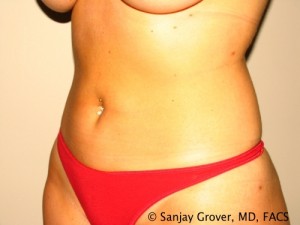 Tummy Tuck Before and After 83 | Sanjay Grover MD FACS