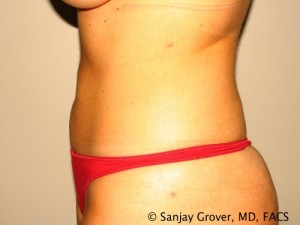 Tummy Tuck Before and After 83 | Sanjay Grover MD FACS