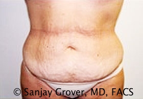Tummy Tuck Before and After | Grover Aesthetics