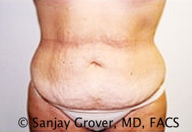 Tummy Tuck Before and After 42 | Sanjay Grover MD FACS