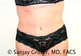 Tummy Tuck Before and After | Grover Aesthetics