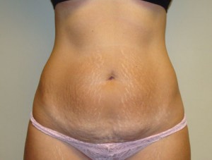 Tummy Tuck Before and After | Grover Aesthetics