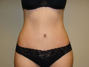 Tummy Tuck Before and After | Grover Aesthetics