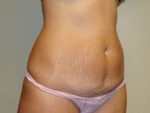 Tummy Tuck Before and After 85 | Grover Aesthetics
