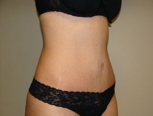 Tummy Tuck Before and After 85 | Grover Aesthetics