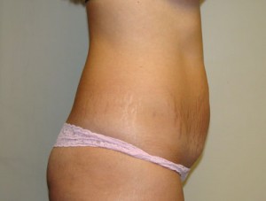 Tummy Tuck Before and After 85 | Grover Aesthetics