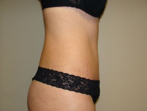 Tummy Tuck Before and After 85 | Grover Aesthetics