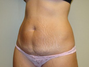Tummy Tuck Before and After 85 | Grover Aesthetics
