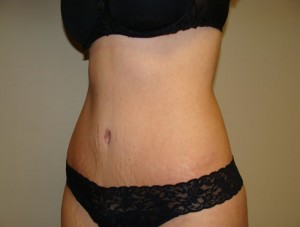 Tummy Tuck Before and After 85 | Grover Aesthetics