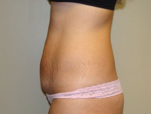 Tummy Tuck Before and After 85 | Grover Aesthetics