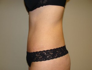 Tummy Tuck Before and After 85 | Grover Aesthetics