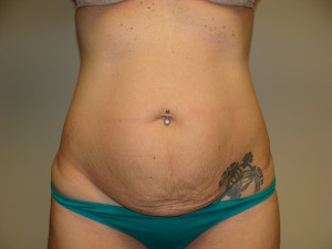 Tummy Tuck Before and After | Grover Aesthetics