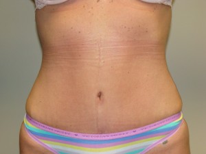 Tummy Tuck Before and After | Grover Aesthetics