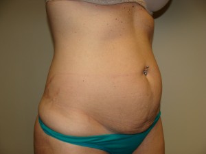 Tummy Tuck Before and After 86 | Grover Aesthetics