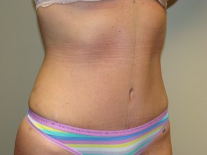 Tummy Tuck Before and After 86 | Sanjay Grover MD FACS