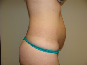 Tummy Tuck Before and After 86 | Grover Aesthetics