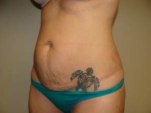 Tummy Tuck Before and After 86 | Grover Aesthetics
