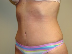 Tummy Tuck Before and After 86 | Sanjay Grover MD FACS