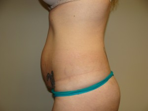 Tummy Tuck Before and After 86 | Grover Aesthetics