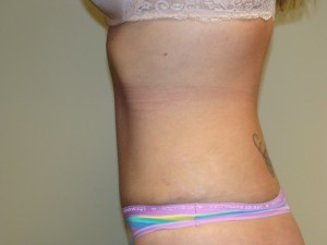 Tummy Tuck Before and After 86 | Grover Aesthetics