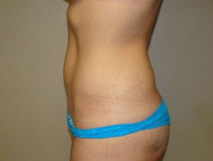 Tummy Tuck Before and After 87 | Grover Aesthetics